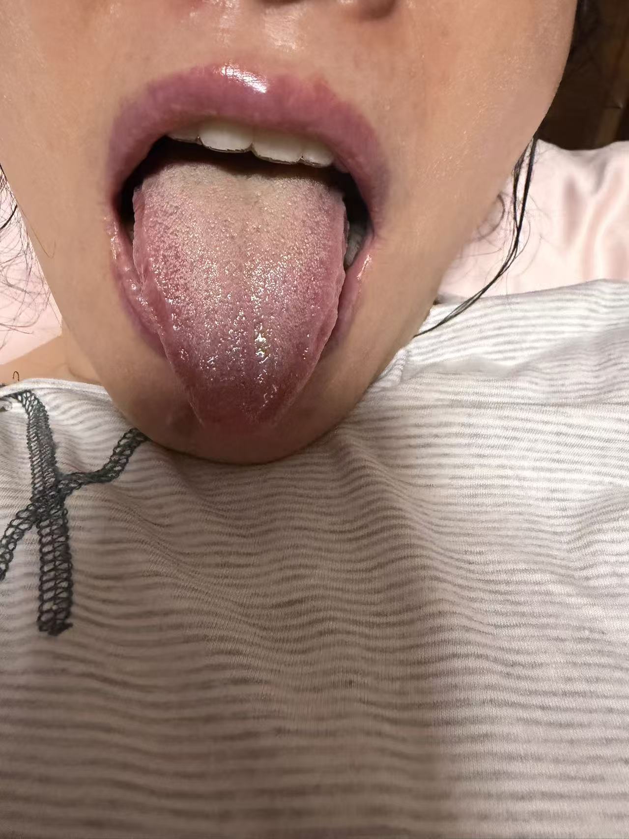 本次舌象正面照片